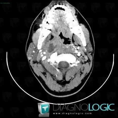 Submandibular Abscess Ct Scan