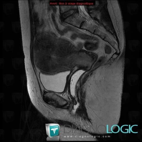 Cas Radiologie Cancer Du Col Ut Rin Irm Diagnologic