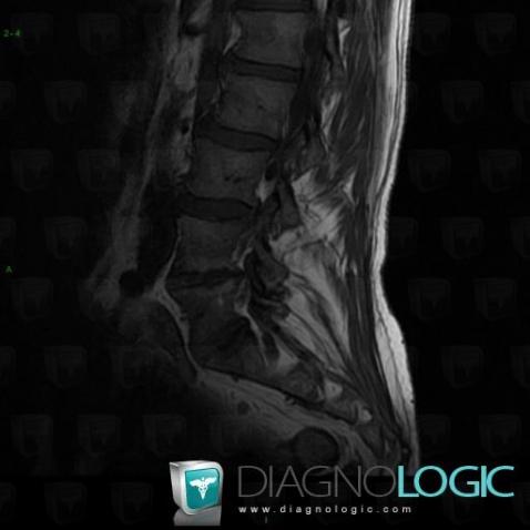 Cas Radiologie Discopathie D G N Rative Irm Diagnologic