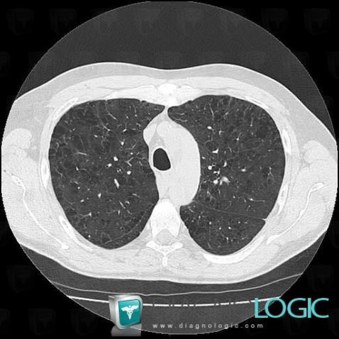 Cas Radiologie Emphys Me Centrolobulaire Scanner Diagnologic