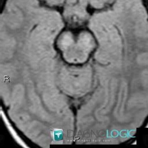 Cas Radiologie Hamartome Irm Diagnologic