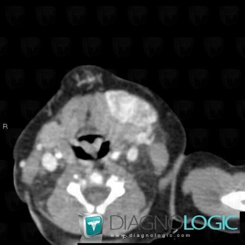 Cas radiologie Hémangiome Scanner Diagnologic