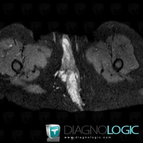 Cas Radiologie H Mangiome Irm Diagnologic