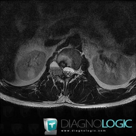 Cas Radiologie M Tastase Scanner Irm Diagnologic