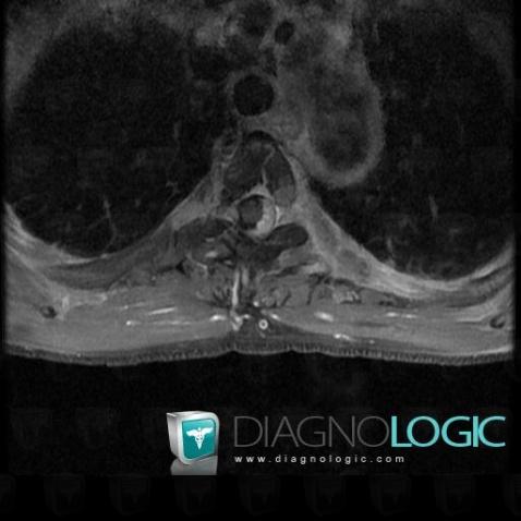 Cas Radiologie M Tastase Irm Diagnologic