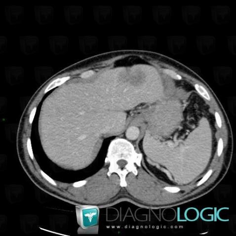 Cas Radiologie M Tastase Scanner Diagnologic