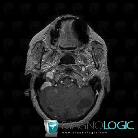 Cas Radiologie M Tastase Scanner Irm Diagnologic