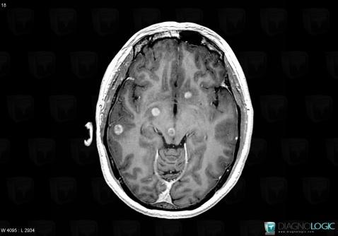 Cas Radiologie M Tastase Irm Diagnologic