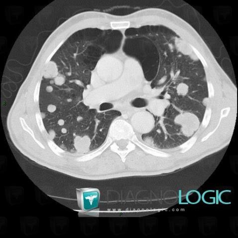 Cas Radiologie M Tastase Echographie Scanner Diagnologic