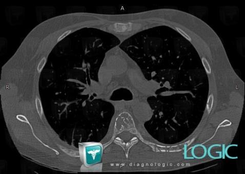 Cas radiologie Myélome multiple IRM Scanner Diagnologic