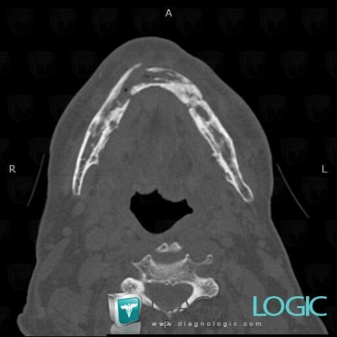 Cas Radiologie L Sion Osseuse Post Radioth Rapie Scanner Diagnologic