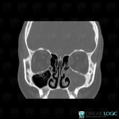 Radiology Case Sinusitis Ct Diagnologic