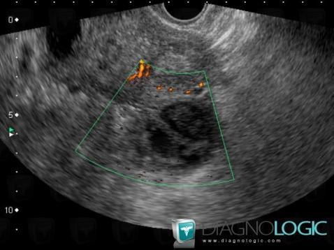 Radiology Case Tubo Ovarian Abscess Us Ct Mri Diagnologic