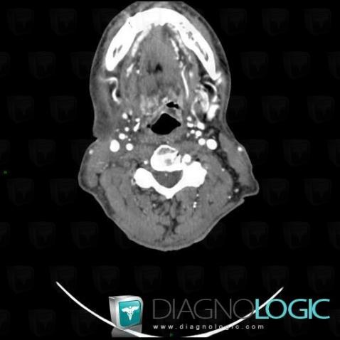 œdème postradique, Larynx, Scanner