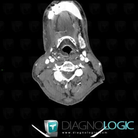 œdème postradique, Pharyngolarynx, Scanner