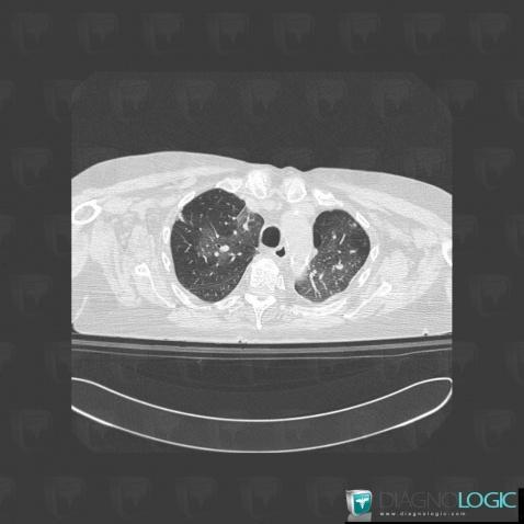 œdème pulmonaire, Parenchyme pulmonaire, Scanner