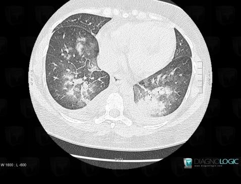 œdème pulmonaire, Parenchyme pulmonaire, Scanner