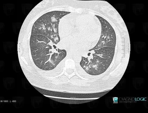 œdème pulmonaire, Parenchyme pulmonaire, Scanner