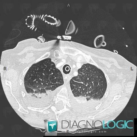 œdème pulmonaire, Parenchyme pulmonaire, Scanner