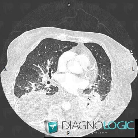 œdème pulmonaire, Parenchyme pulmonaire, Scanner