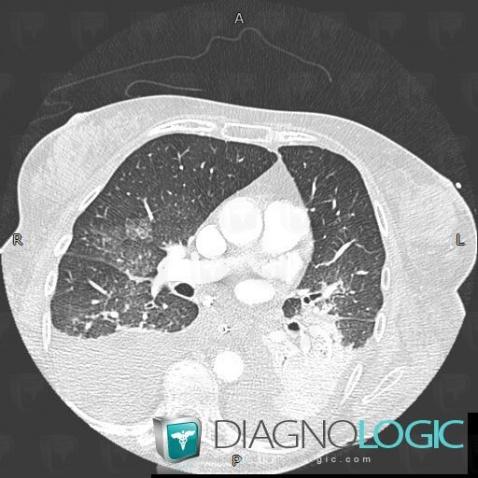 œdème pulmonaire, Parenchyme pulmonaire, Scanner