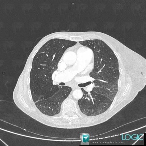 œdème pulmonaire, Parenchyme pulmonaire, Scanner