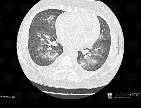 œdème pulmonaire, Voies aériennes, Scanner