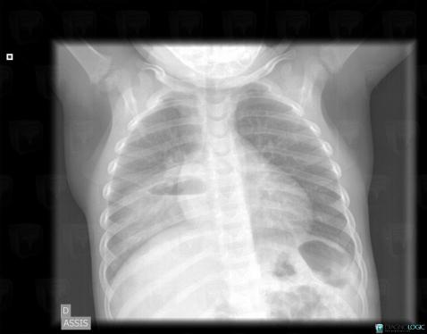 Abcès, Parenchyme pulmonaire, Radio