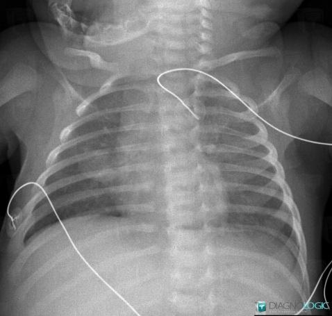 Abcès, Parenchyme pulmonaire, Radio