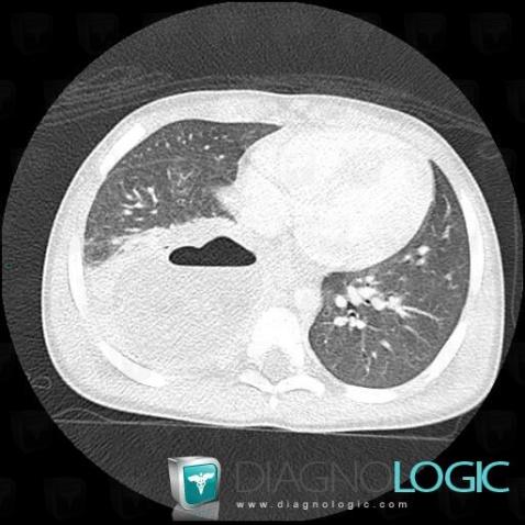 Abcès, Parenchyme pulmonaire, Scanner