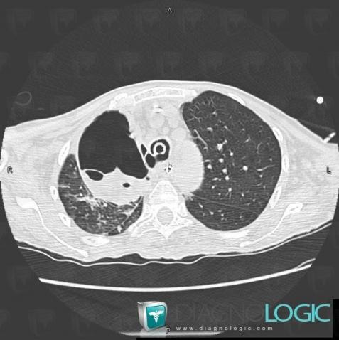 Abcès, Parenchyme pulmonaire, Scanner