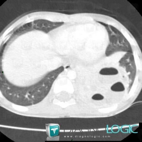 Abcès, Parenchyme pulmonaire, Scanner