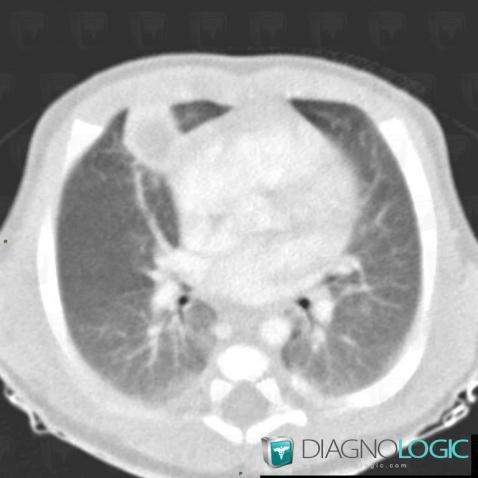 Abcès, Parenchyme pulmonaire, Scanner