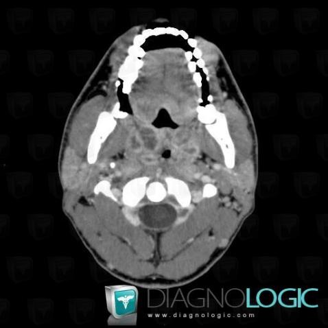 Abcès périamygdalien, Oropharynx / Plancher buccal, Scanner