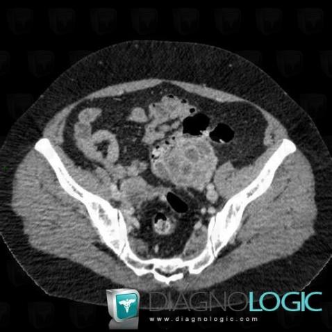 Abcès tubo ovarien, Annexe / Ovaire - trompe, Pelvis / Périnée, Scanner