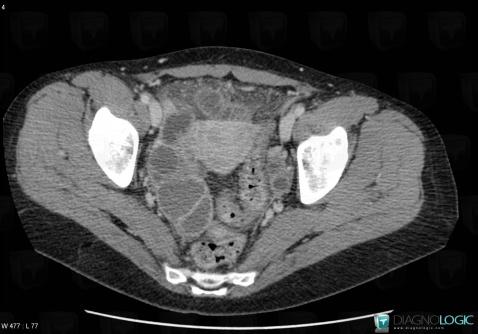 Abcès tubo ovarien, Annexe / Ovaire - trompe, Pelvis / Périnée, Scanner