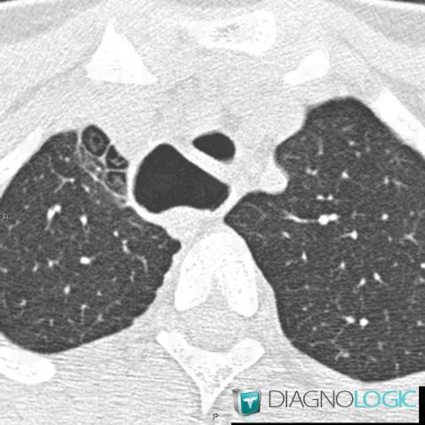 Aberrant right subclavian artery, Oesophagus, CT