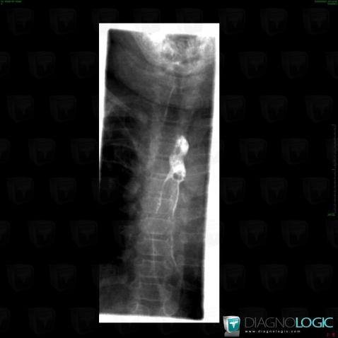 Aberrant right subclavian artery, Oesophagus, X rays