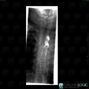 Aberrant right subclavian artery, Oesophagus, X rays