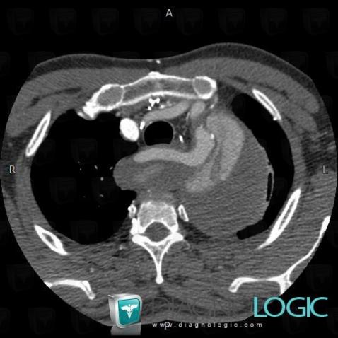 Aberrant right subclavian artery, Supra aortic vessels, CT