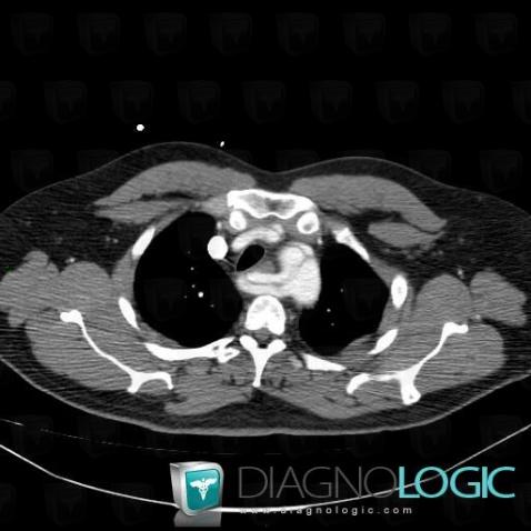 Aberrant right subclavian artery, Supra aortic vessels, CT