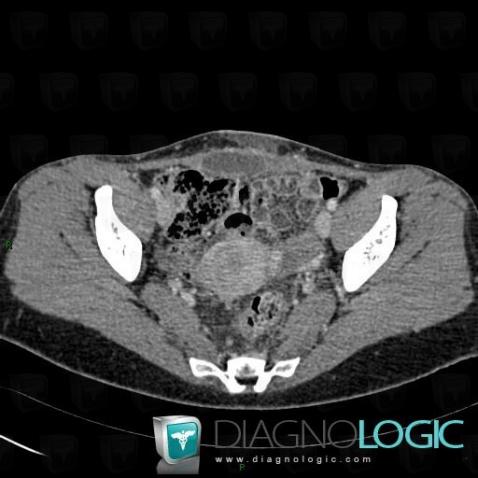 Abscess, Abdominal wall, CT