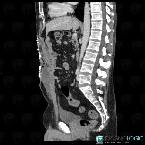 Abscess, Abdominal wall, CT