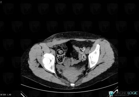 Abscess, Abdominal wall, CT