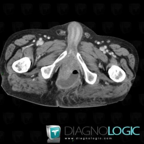 Abscess, Anus, Pelvis / Perineum, CT