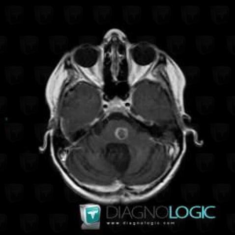 Abscess, Brainstem, Posterior fossa, MRI