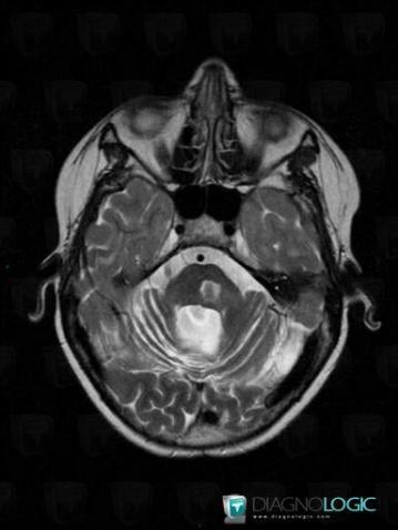 Abscess, Brainstem, Posterior fossa, MRI