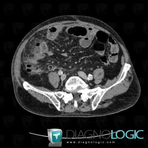 Abscess, Caecum / Appendix, CT