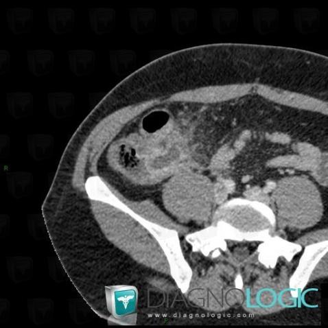 Abscess, Caecum / Appendix, CT