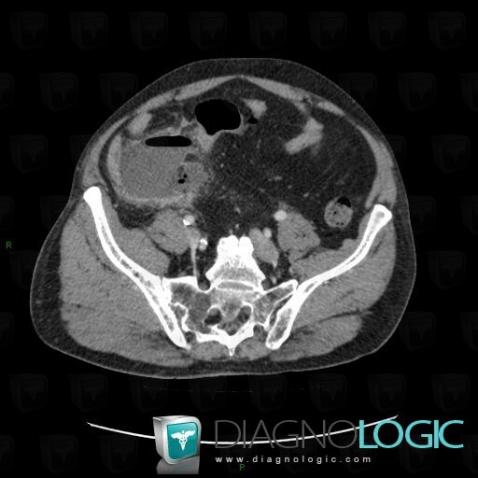 Abscess, Caecum / Appendix, CT